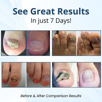 ⚡Visible Results In 2 Days + Professional Grade Repair🏥AEXZR® MycoShield Pro Fungal Nail Patches