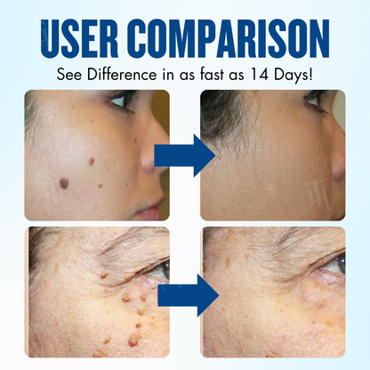 🔥EXCLUSIVE: Professional-Grade Skin Restoration Now Available at Home | AEXZR® Protocol Cream: Remove Tags, Keep Perfect Skin⭐