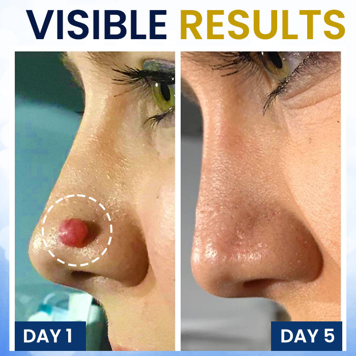 ✨ Painless At-Home Removal | AEXZR® Skin Tag Cryo Treatment Spray