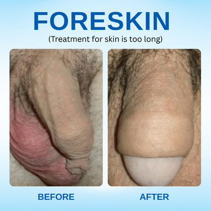 ⚡See Results in Just 24 hours – RZXEA™ Redundant Prepuce Corrector Gel